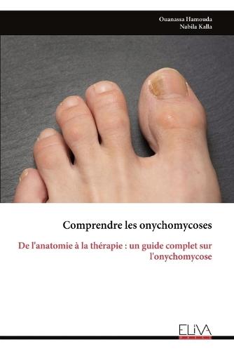 Comprendre les onychomycoses: De l'anatomie à la thérapie: un guide complet sur l'onychomycose