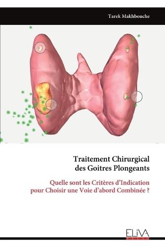 Traitement Chirurgical des Goitres Plongeants: Quelle sont les Critères d'Indication pour Choisir une Voie d'abord Combinée ?