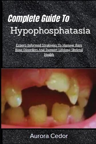 Complete Guide To Hypophosphatasia: Expert-Informed Strategies To Manage Rare Bone Disorders And Support Lifelong Skeletal Health
