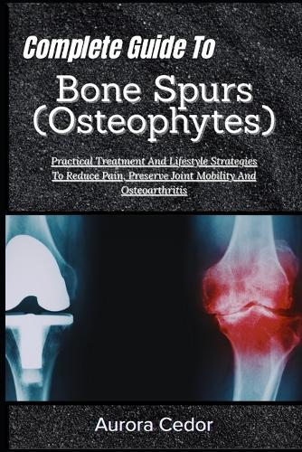Complete Guide To Bone Spurs (Osteophytes): Practical Treatment And Lifestyle Strategies To Reduce Pain, Preserve Joint Mobility And Osteoarthritis