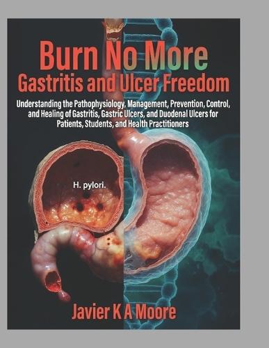 Burn No More: Gastritis and Ulcer Freedom: Understanding the Pathophysiology, Management, Prevention, Control, and Healing of Gastritis, Gastric Ulcers, and Duodenal Ulcers for Patients, Students, and Health Practitioners