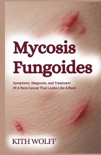 Mycosis Fungoides: Symptoms, Diagnosis, and Treatment of a Rare Cancer That Looks Like a Rash