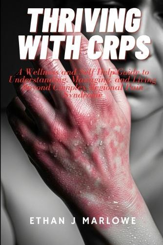 Thriving With CRPS: A Wellness and Self-Help Guide to Understanding, Managimg, and Living Beyond Complex Regional Pain Syndrome