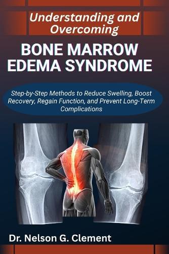 Understanding and Overcoming Bone Marrow Edema Syndrome: Step-by-Step Methods to Reduce Swelling, Boost Recovery, Regain Function, and Prevent Long-Term Complications