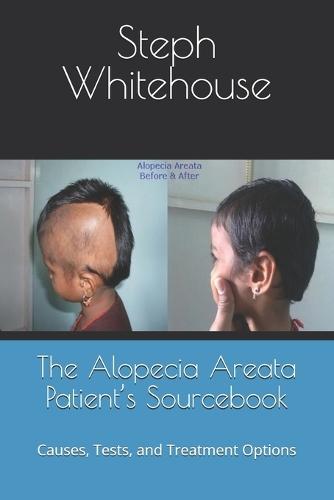The Alopecia Areata Patient's Sourcebook: Causes, Tests, and Treatment Options