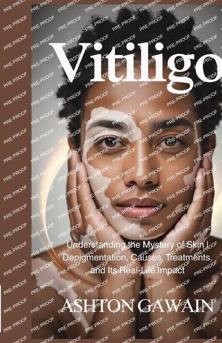 Vitiligo: Understanding the Mystery of Skin Depigmentation, Causes, Treatments, and Its Real-Life Impact