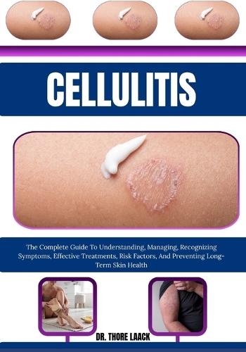 Cellulitis: The Complete Guide To Understanding, Managing, Recognizing Symptoms, Effective Treatments, Risk Factors, And Preventing Long-Term Skin Health