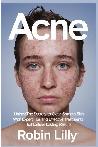 Acne: Unlock the Secrets to Clear, Smooth Skin with Expert Tips and Effective Treatments That Deliver Lasting Results