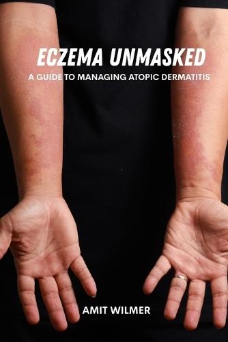 Eczema unmasked: A guide to managing atopic dermatitis