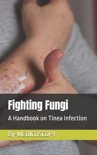 Fighting Fungi: A Handbook on Tinea Infection