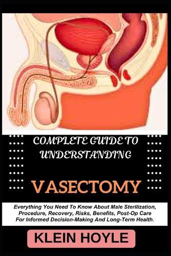 Complete Guide to Understanding Vasectomy: Everything You Need To Know About Male Sterilization, Procedure, Recovery, Risks, Benefits, Post-Op Care For Informed Decision-Making And Long-Term Health.