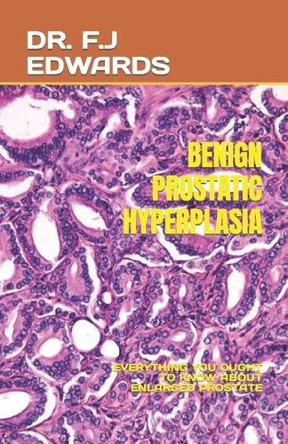 Benign Prostatic Hyperplasia: Everything You Ought to Know about Enlarged Prostate