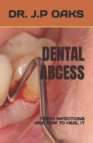 Dental Abcess: Teeth Infections and How to Heal It