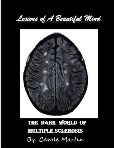 Lesions of A Beautiful Mind: The Dark World of Multiple Sclerosis