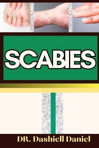 Scabies: Expert Guide To Understanding Scabies Causes, Symptoms, Preventing, Treatment for optimal wellness