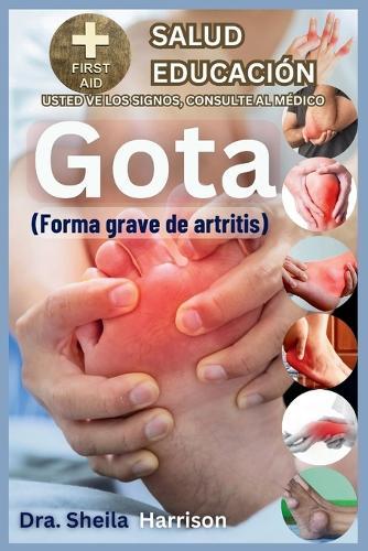 Gota: forma grave de artritis: Causas, Síntomas, Manejo de Modificadores de Riesgo, Tratamiento, MEDICAMENTOS (APROBADOS MUNDIALMENTE), Prevención, Alimentos y Dieta tanto para tener como para evitar