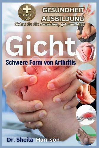 Gicht: Schwere Form der Arthritis: Ursachen, Symptome, Risikomodifikatoren, Management, Behandlung, MEDIKAMENTE (WELTWEIT GENEHMIGT), Prävention, Lebensmittel und Ernährung, die man haben und vermeid