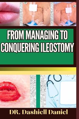 From Managing to Conquering Ileostomy: Expert Guide To Understanding the Causes, Recognizing Symptoms, Prevention and Embracing Effective Treatments for a Vibrant and Healthy Life
