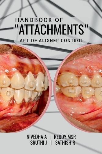 Handbook of ""Attachments"": Art of Aligner Control