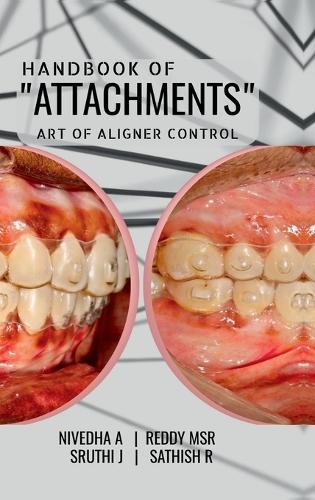 Handbook of ""Attachments"": Art of Aligner Control