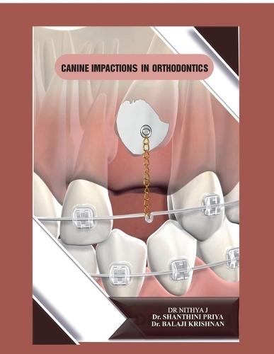 Canine Impactions in Orthodontics