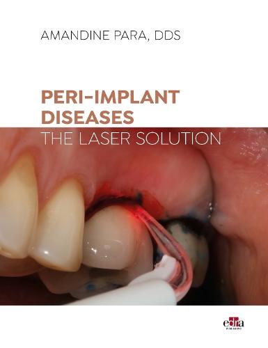 Peri-implant Diseases: The Laser Solution