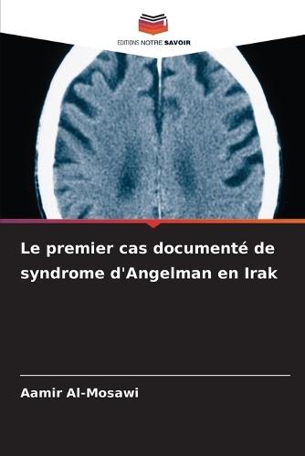 Le premier cas documenté de syndrome d'Angelman en Irak
