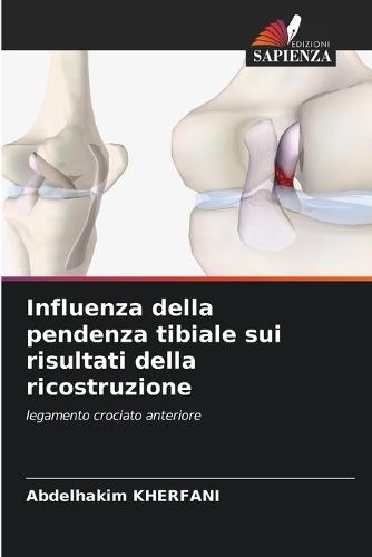 Influenza della pendenza tibiale sui risultati della ricostruzione