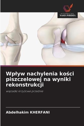 Wplyw nachylenia kości piszczelowej na wyniki rekonstrukcji