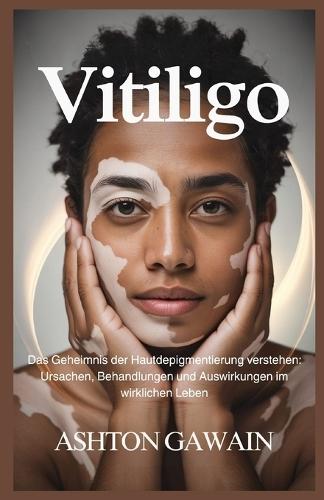 Vitiligo: Das Geheimnis der Hautdepigmentierung verstehen: Ursachen, Behandlungen und Auswirkungen im wirklichen Leben