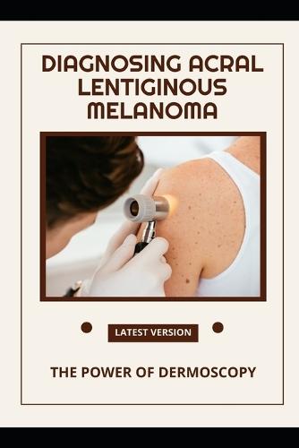 Diagnosing Acral Lentiginous Melanoma: The Power of Dermoscopy